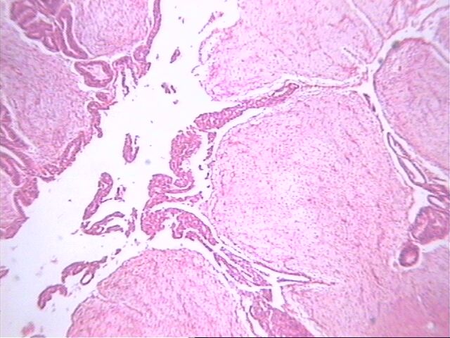 Fig. 3   Proliferacin epitelial en un phyllodes - <div style=